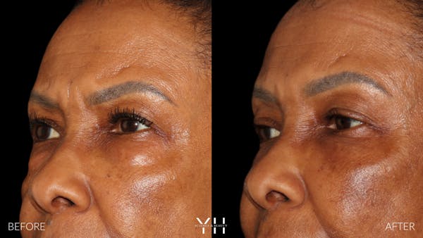  Blepharoplasty Before & After Gallery - Patient 323099 - Image 5