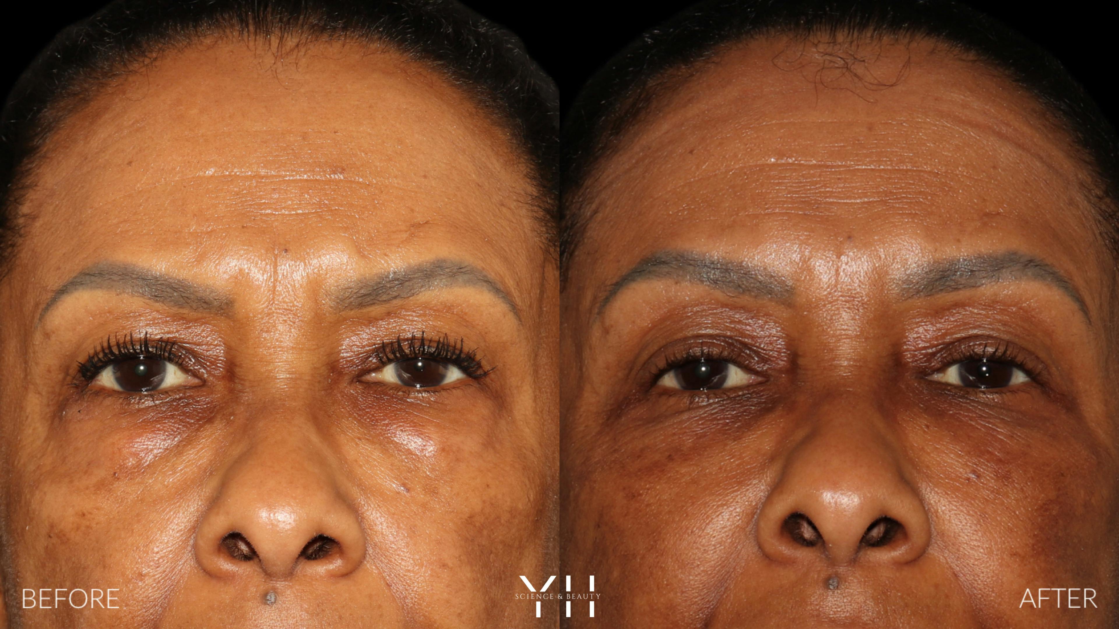 Before and After Eyelid Surgery