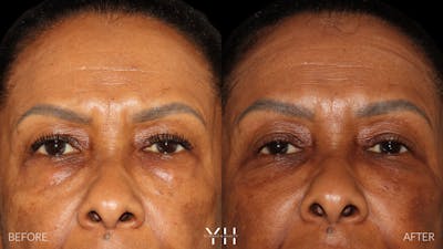  Blepharoplasty Before & After Gallery - Patient 323099 - Image 1