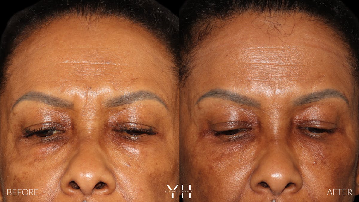  Blepharoplasty Before & After Gallery - Patient 323099 - Image 2