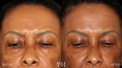  Blepharoplasty Before & After Gallery - Patient 323099 - Image 2