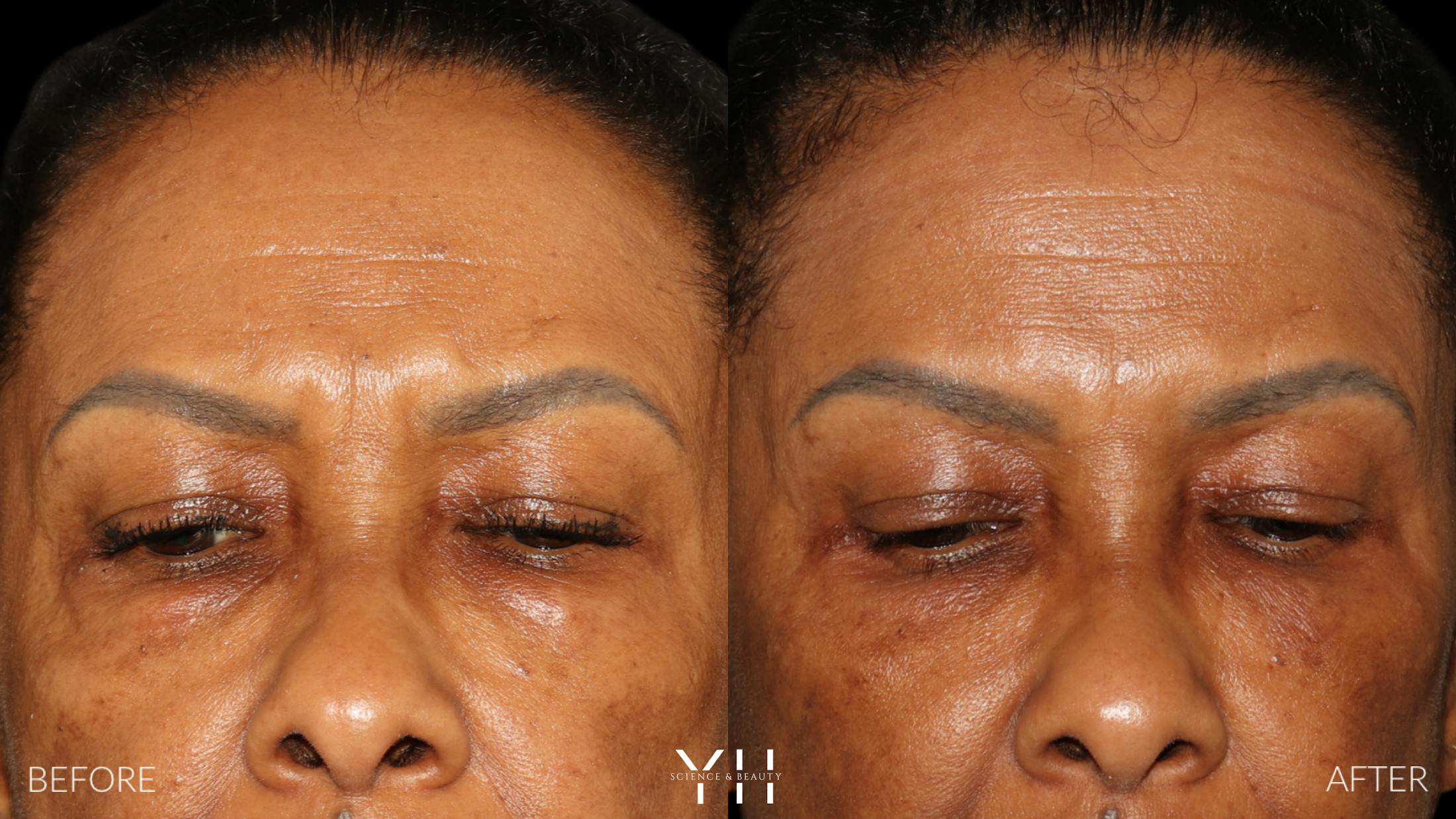 Blepharoplasty Before & After Gallery - Patient 323099 - Image 2