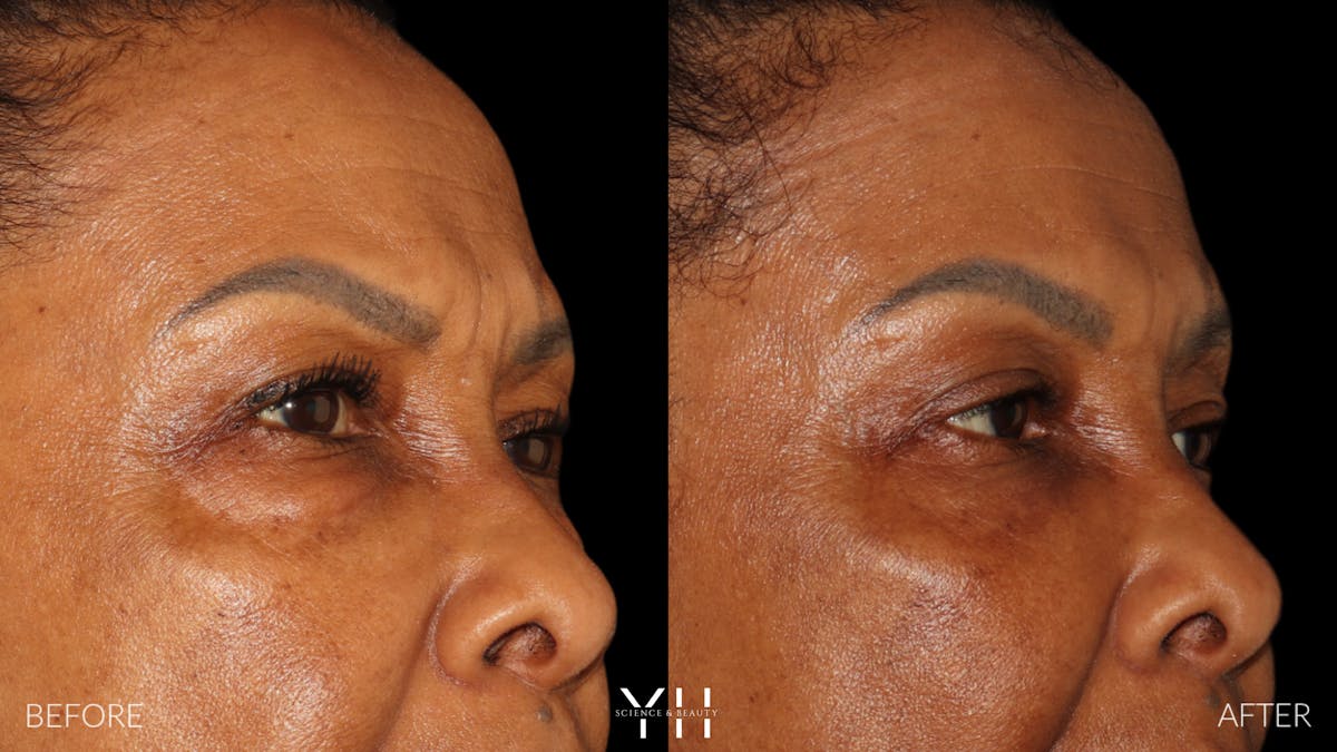  Blepharoplasty Before & After Gallery - Patient 323099 - Image 3