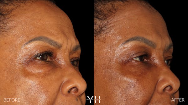  Blepharoplasty Before & After Gallery - Patient 323099 - Image 3