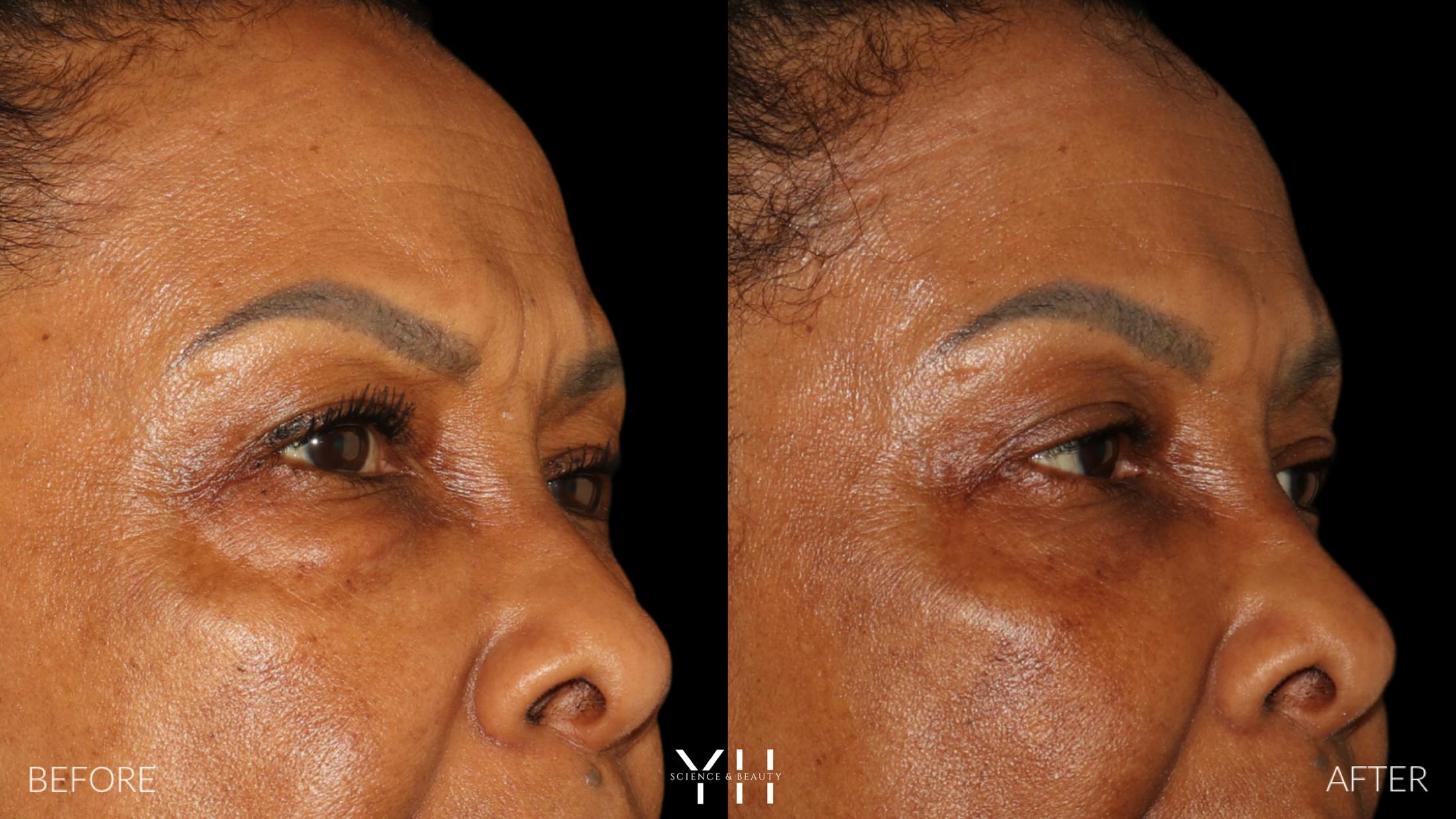 Blepharoplasty Before & After Gallery - Patient 323099 - Image 3