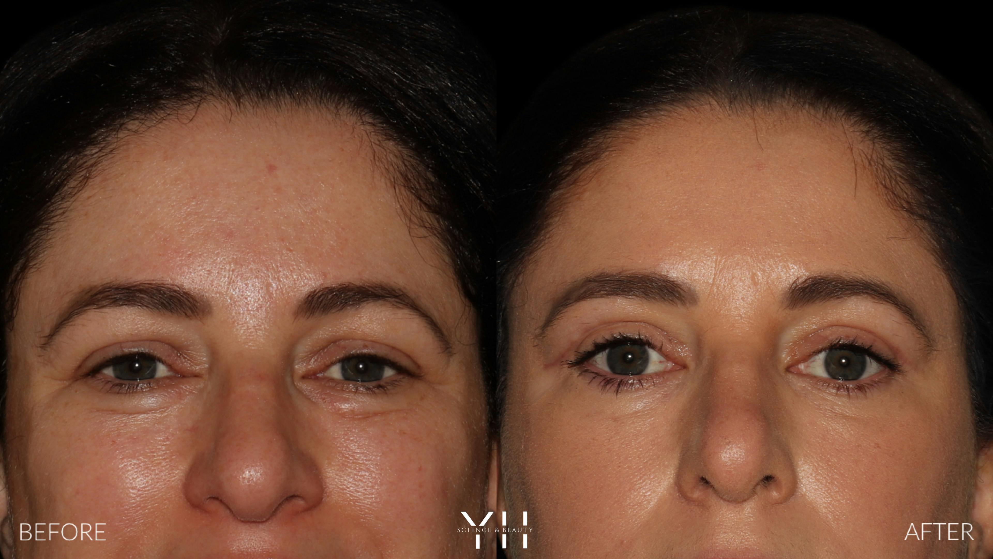 Before and After Eyelid Surgery