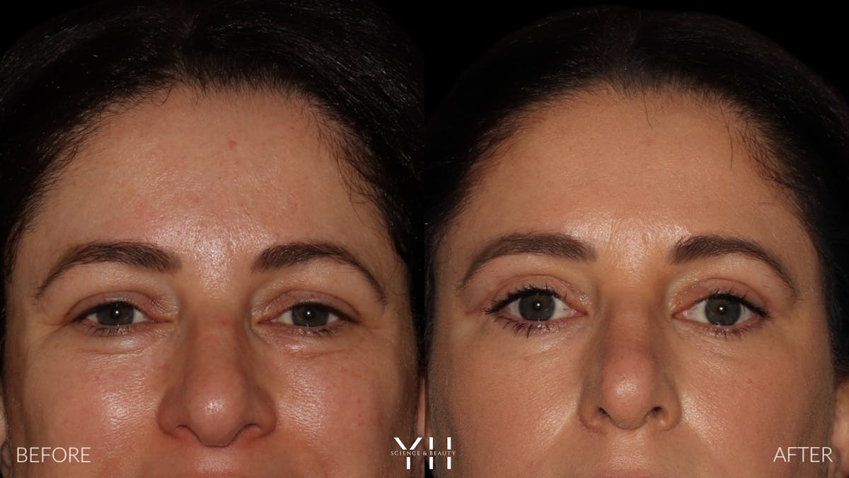  Blepharoplasty Before & After Gallery - Patient 350462 - Image 1