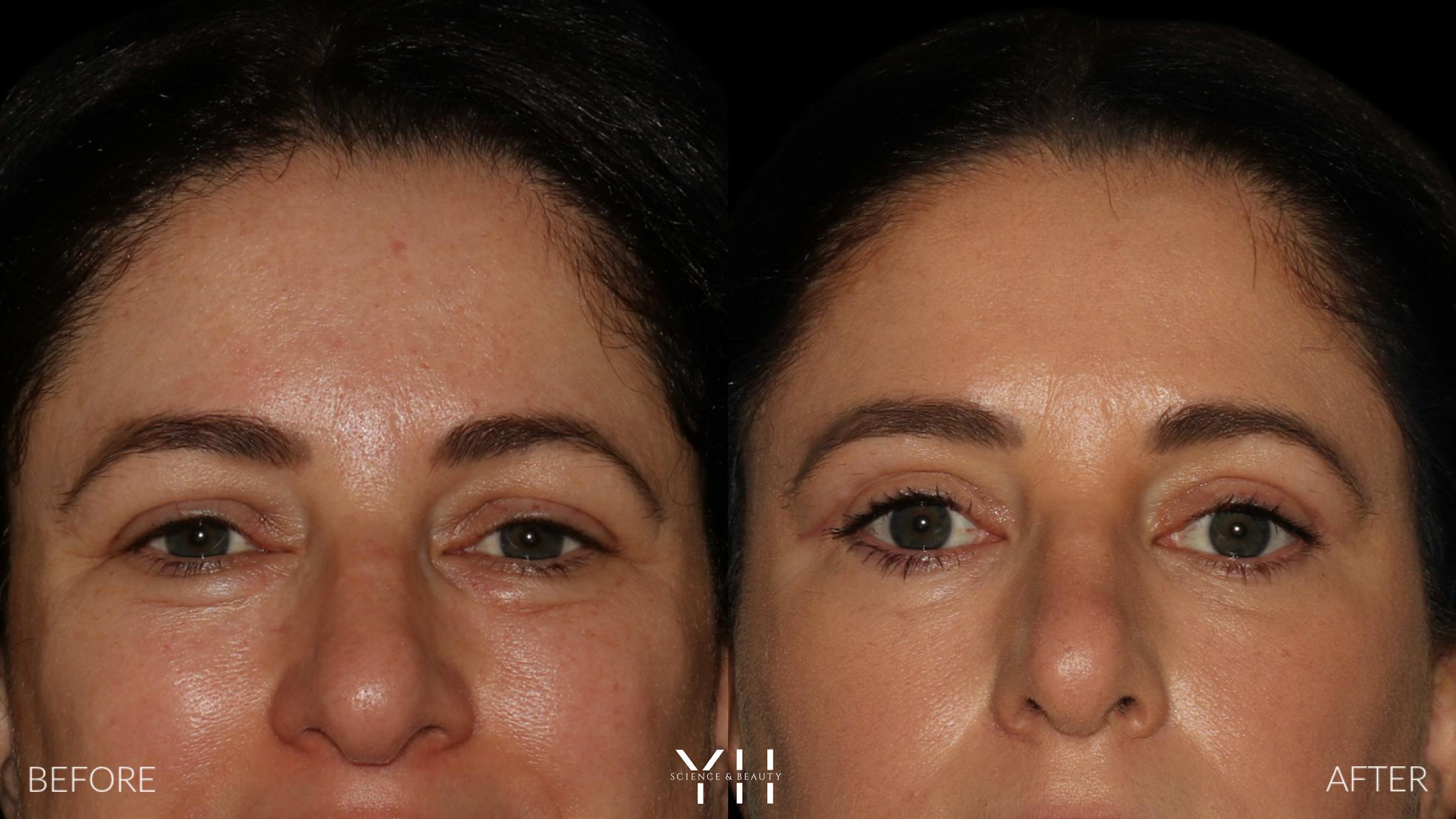 Blepharoplasty Before & After Gallery - Patient 350462 - Image 1