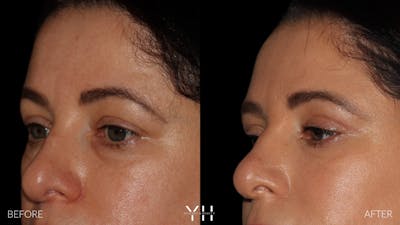  Blepharoplasty Before & After Gallery - Patient 350462 - Image 2
