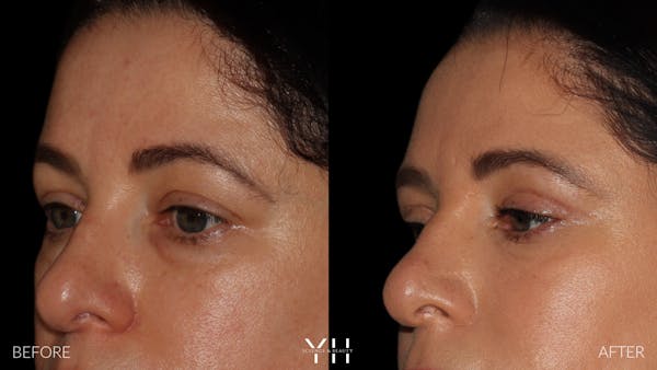  Blepharoplasty Before & After Gallery - Patient 350462 - Image 2