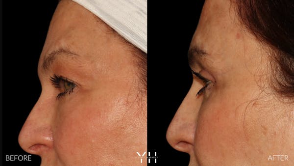  Blepharoplasty Before & After Gallery - Patient 142457 - Image 5