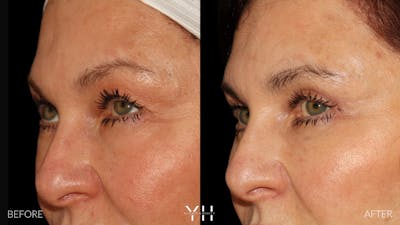  Blepharoplasty Before & After Gallery - Patient 142457 - Image 4