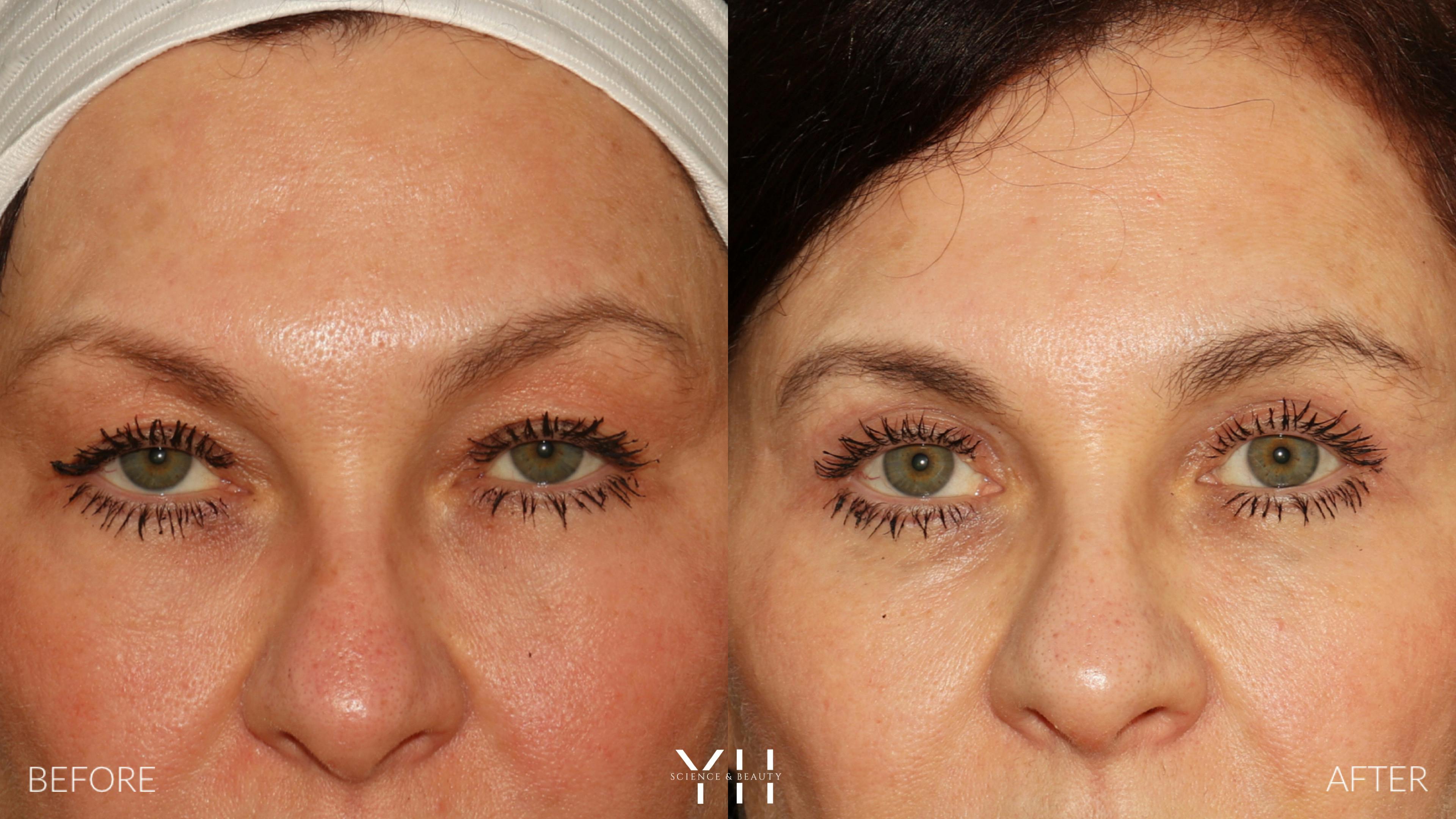 Before and After Eyelid Surgery
