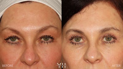  Blepharoplasty Before & After Gallery - Patient 142457 - Image 1