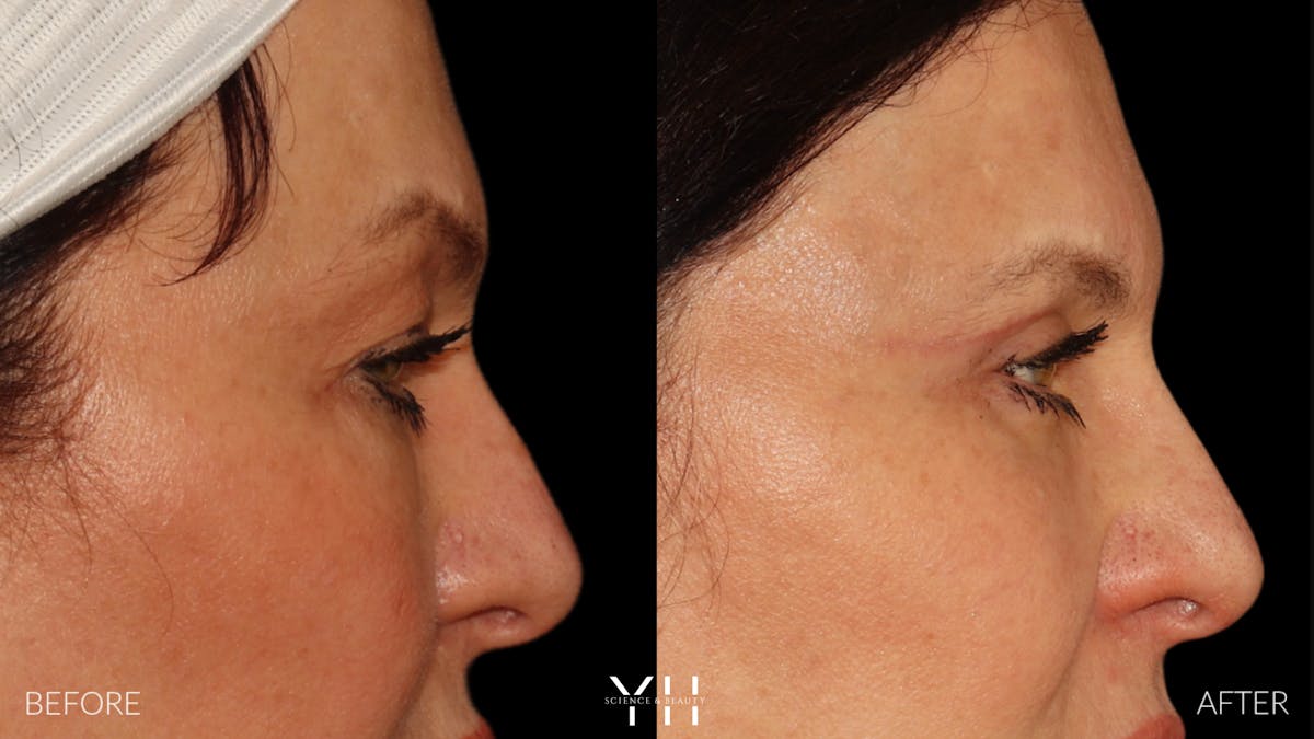  Blepharoplasty Before & After Gallery - Patient 142457 - Image 3