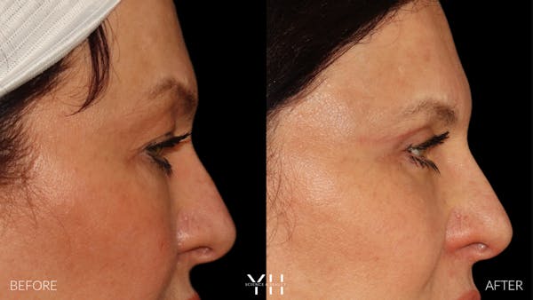  Blepharoplasty Before & After Gallery - Patient 142457 - Image 3