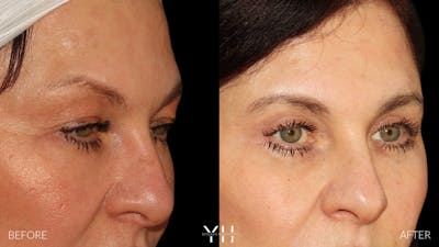 Blepharoplasty Before & After Gallery - Patient 142457 - Image 2