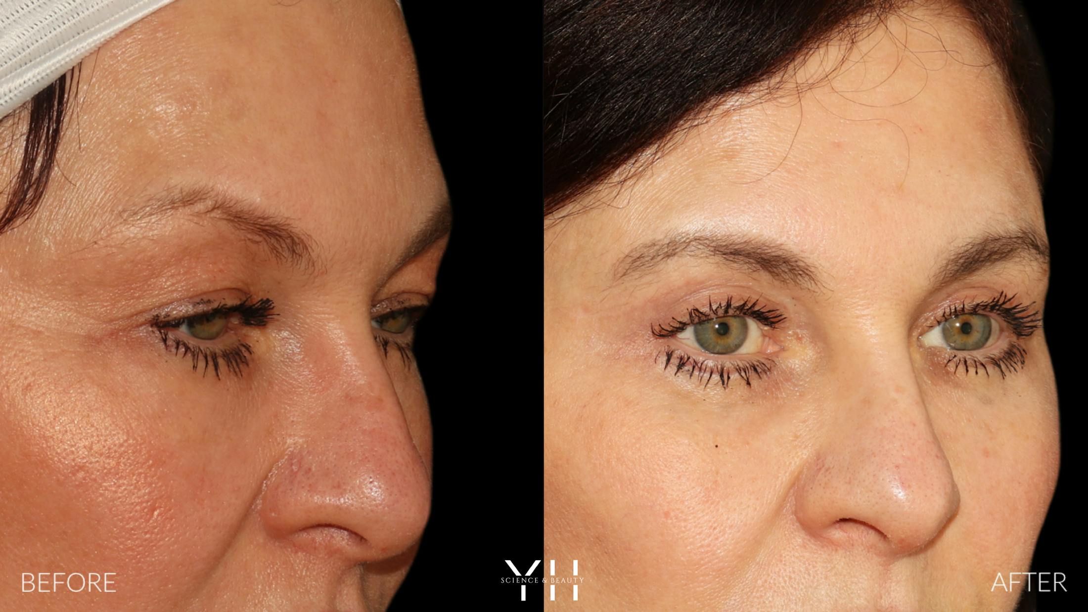 Blepharoplasty Before & After Gallery - Patient 142457 - Image 2