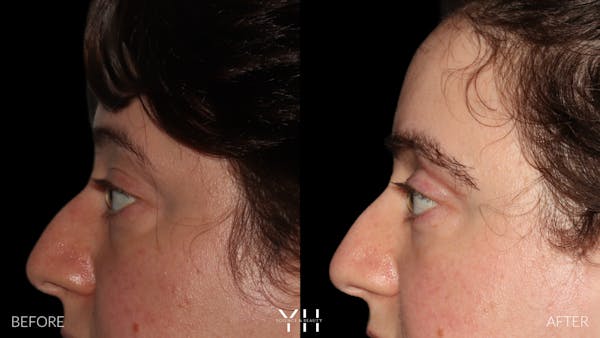  Blepharoplasty Before & After Gallery - Patient 283593 - Image 5