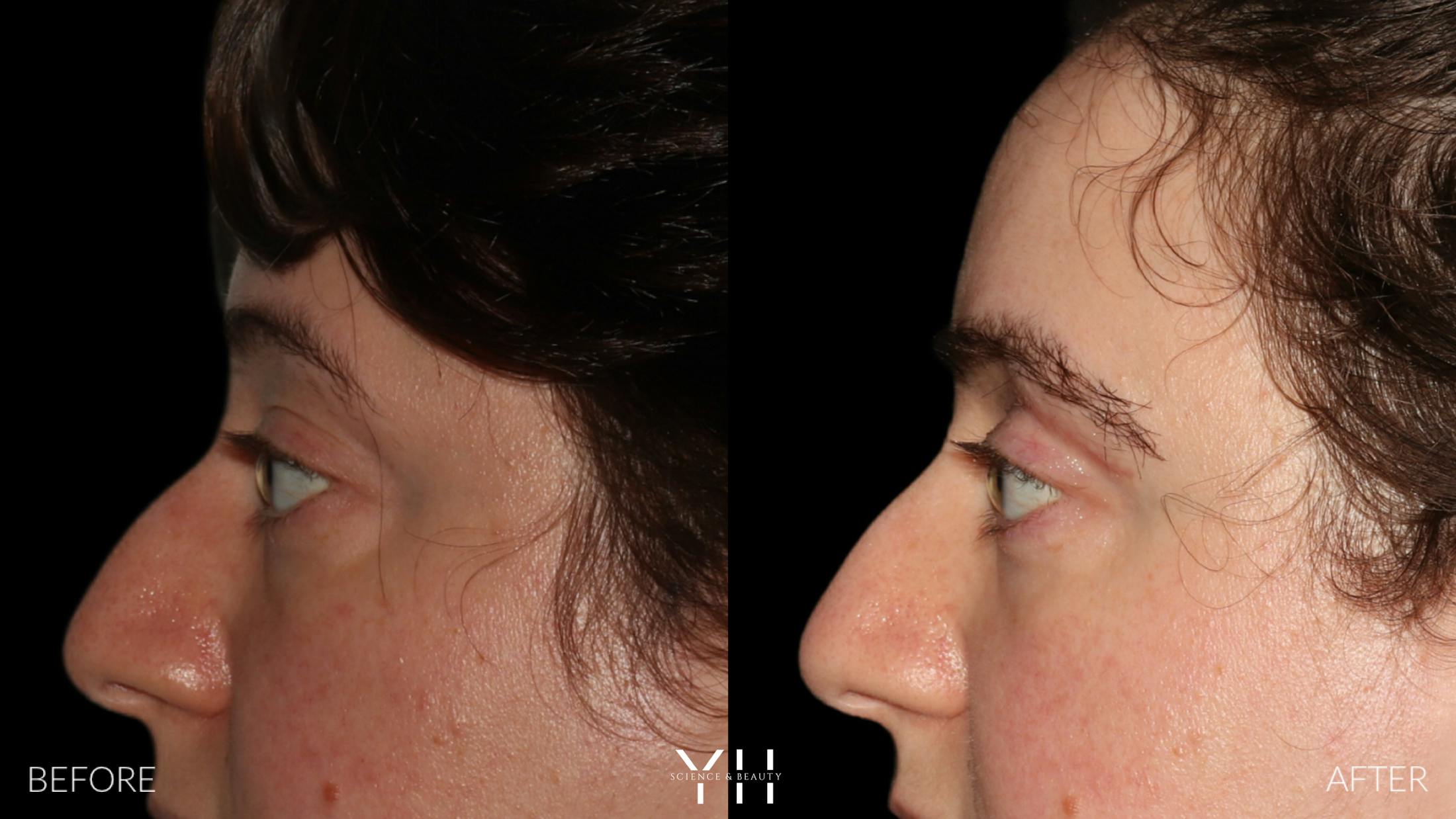 Blepharoplasty Before & After Gallery - Patient 283593 - Image 5