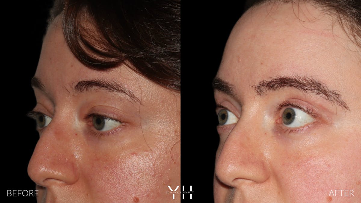  Blepharoplasty Before & After Gallery - Patient 283593 - Image 4