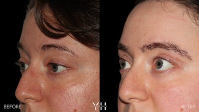  Blepharoplasty Before & After Gallery - Patient 283593 - Image 4