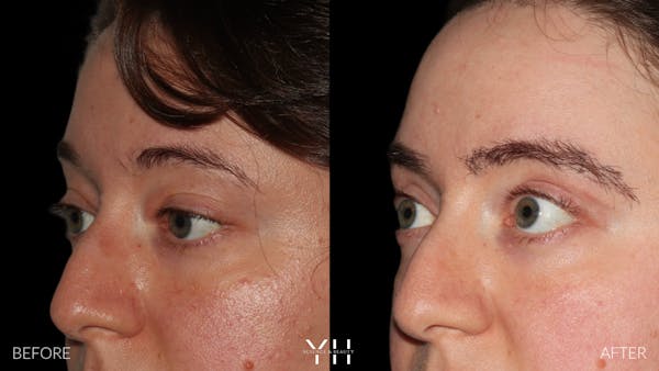  Blepharoplasty Before & After Gallery - Patient 283593 - Image 4