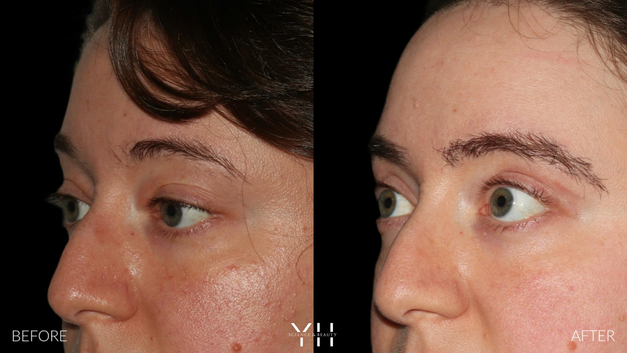 Blepharoplasty Before & After Gallery - Patient 283593 - Image 4
