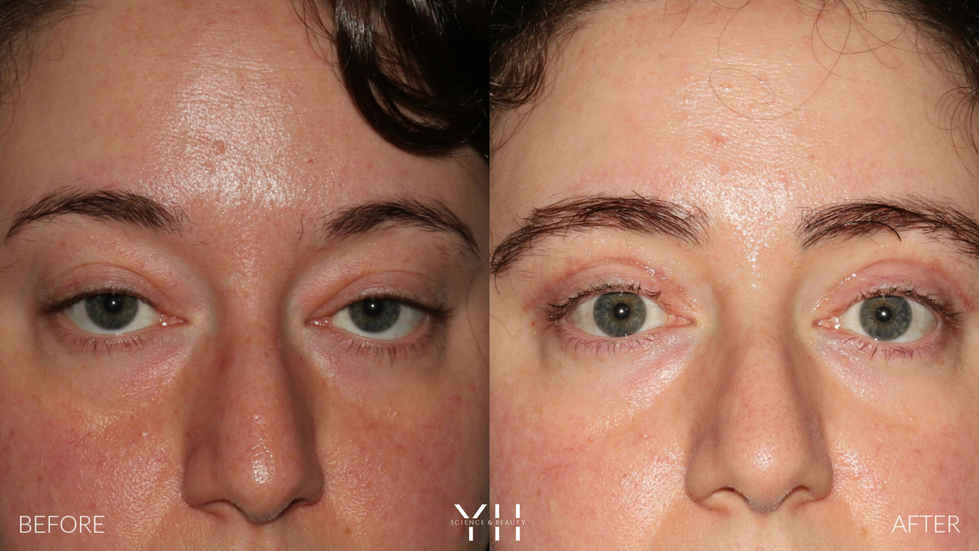 Before and After Eyelid Surgery