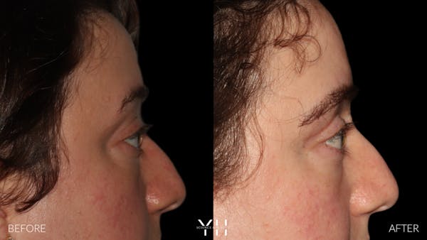  Blepharoplasty Before & After Gallery - Patient 283593 - Image 3