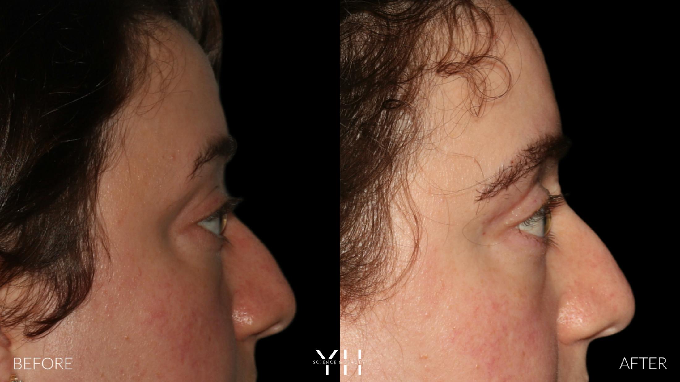 Blepharoplasty Before & After Gallery - Patient 283593 - Image 3