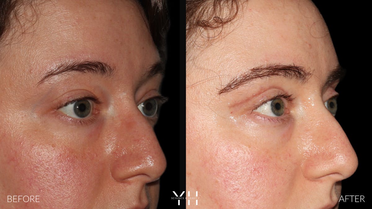  Blepharoplasty Before & After Gallery - Patient 283593 - Image 2