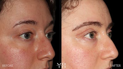 Blepharoplasty Before & After Gallery - Patient 283593 - Image 2