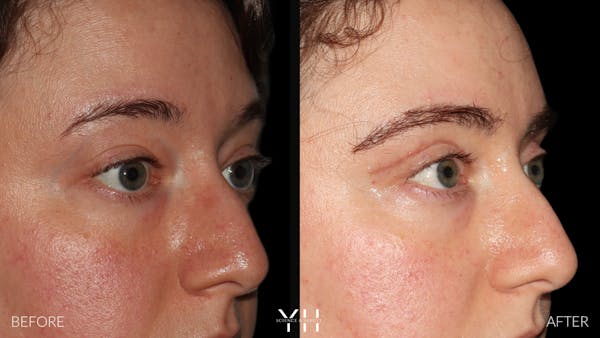  Blepharoplasty Before & After Gallery - Patient 283593 - Image 2