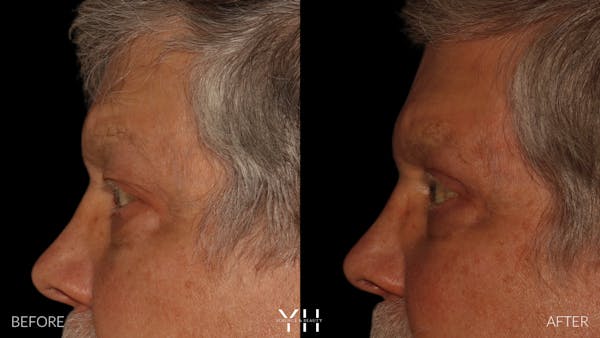  Blepharoplasty Before & After Gallery - Patient 386270 - Image 5