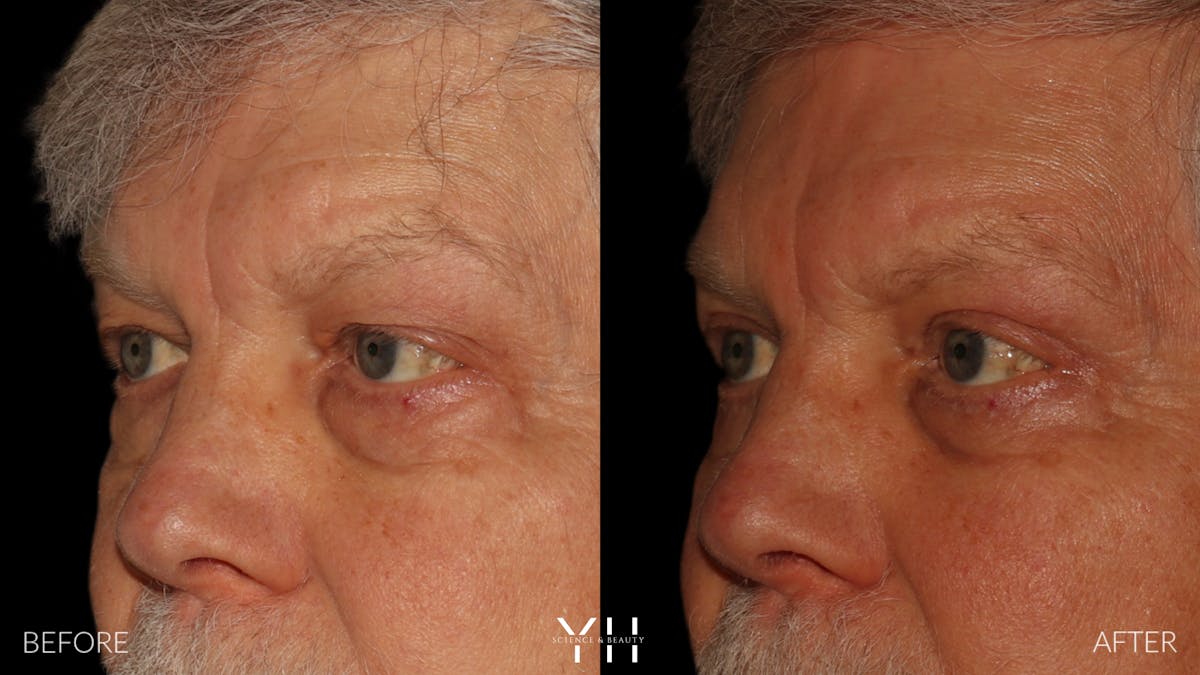  Blepharoplasty Before & After Gallery - Patient 386270 - Image 4