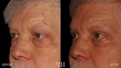 Blepharoplasty Before & After Gallery - Patient 386270 - Image 4