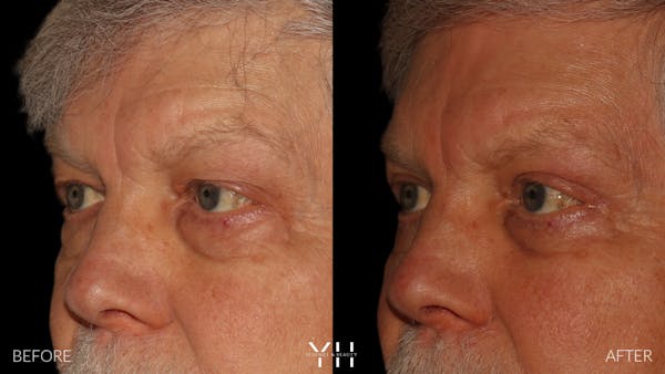  Blepharoplasty Before & After Gallery - Patient 386270 - Image 4
