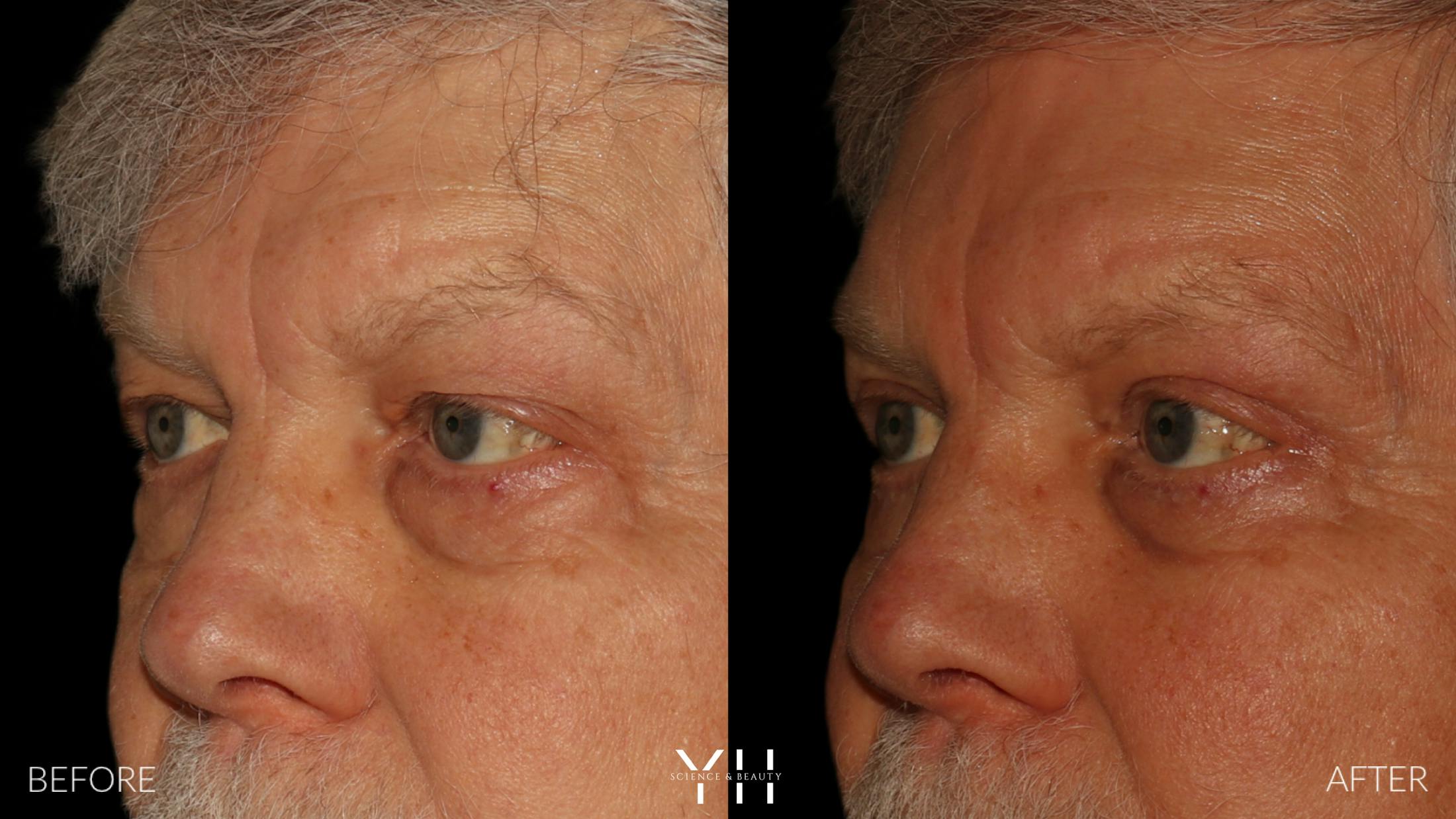 Blepharoplasty Before & After Gallery - Patient 386270 - Image 4