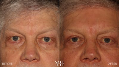  Blepharoplasty Before & After Gallery - Patient 386270 - Image 1