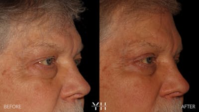  Blepharoplasty Before & After Gallery - Patient 386270 - Image 2