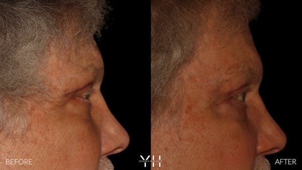  Blepharoplasty Before & After Gallery - Patient 386270 - Image 3