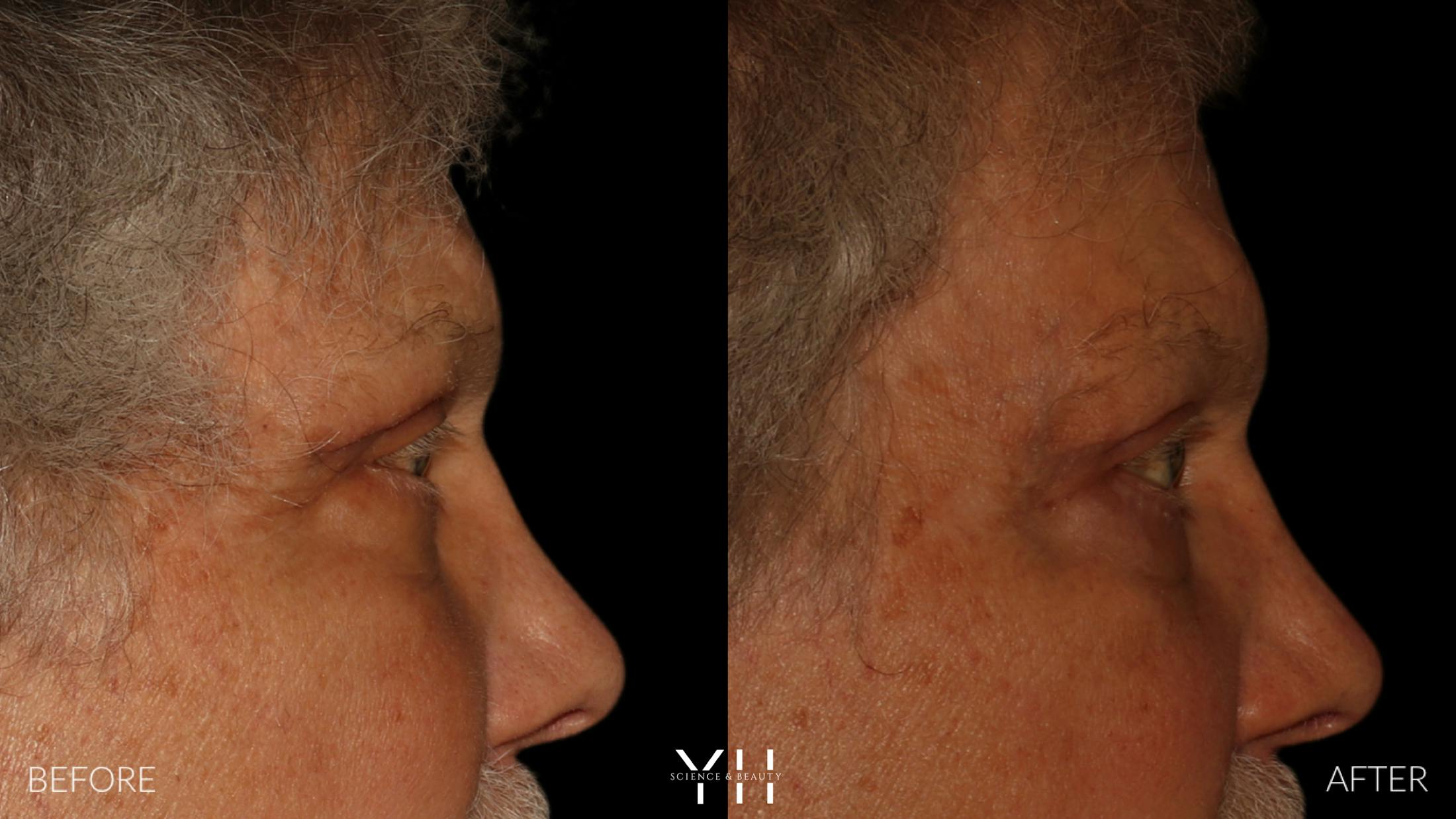 Blepharoplasty Before & After Gallery - Patient 386270 - Image 3