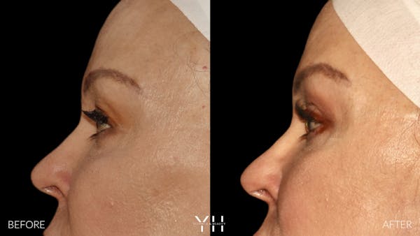  Blepharoplasty Before & After Gallery - Patient 328344 - Image 5