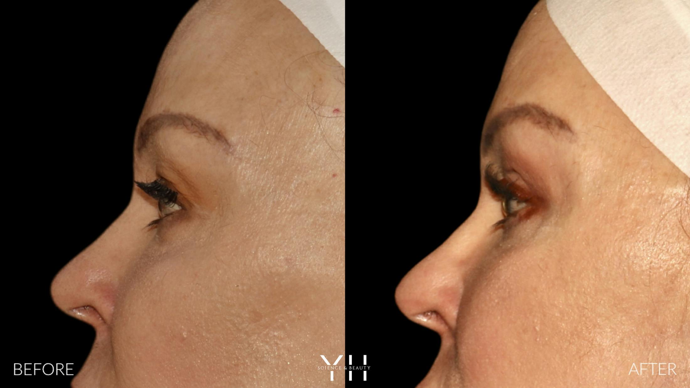 Blepharoplasty Before & After Gallery - Patient 328344 - Image 5