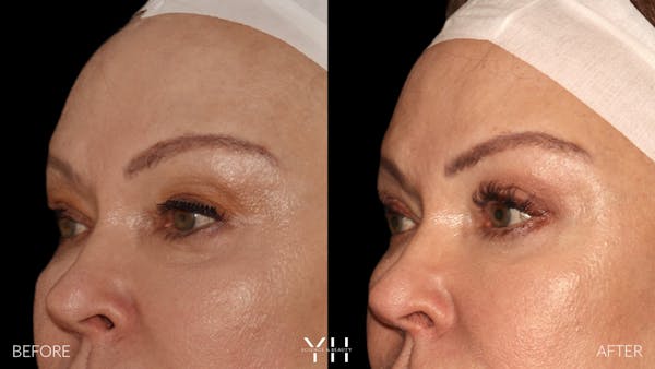  Blepharoplasty Before & After Gallery - Patient 328344 - Image 4