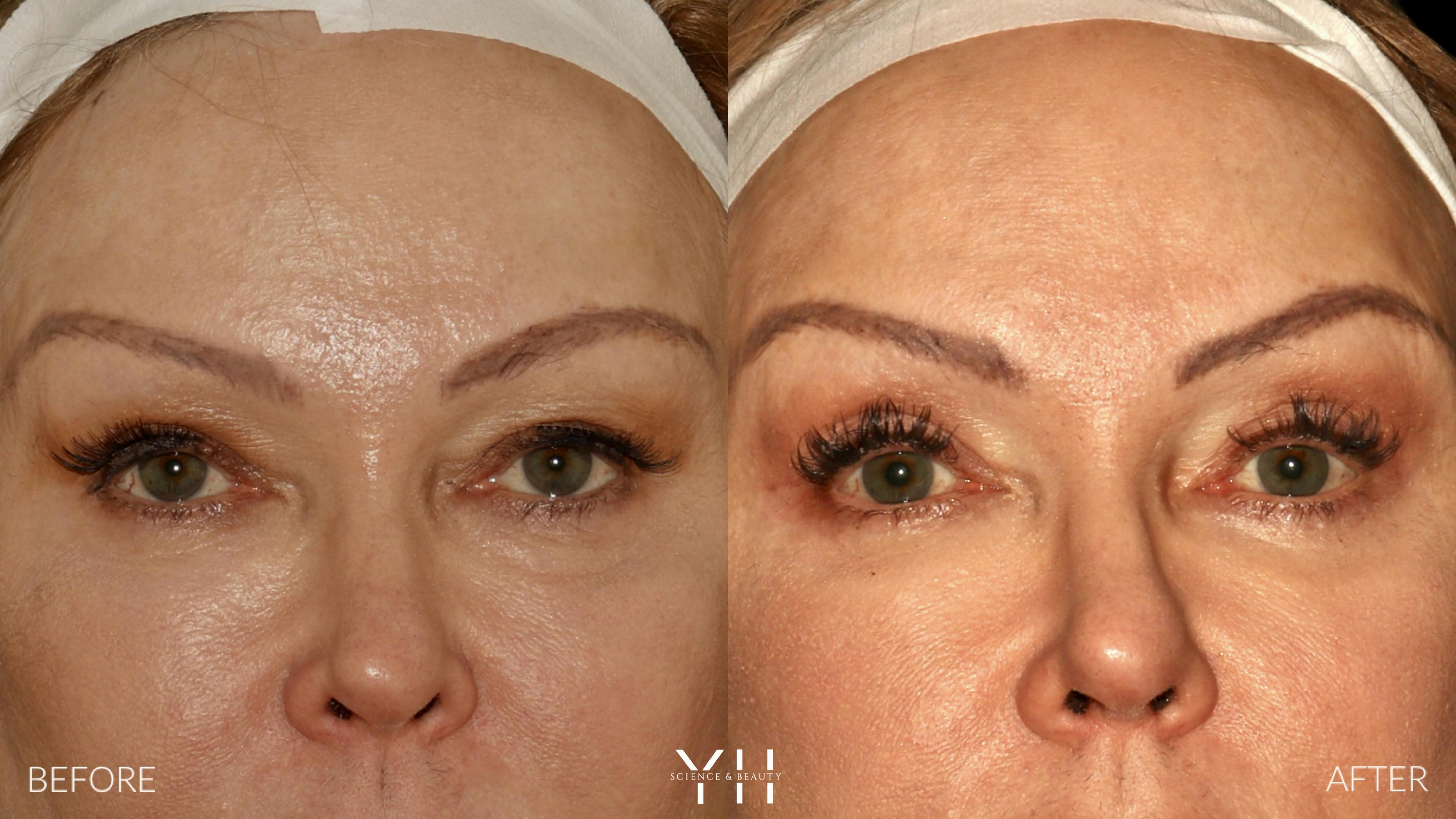 Before and After Eyelid Surgery