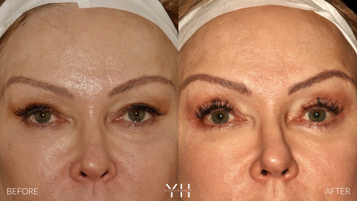  Blepharoplasty Before & After Gallery - Patient 328344 - Image 1