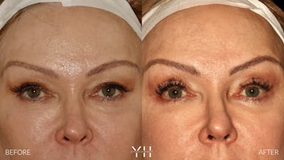 Blepharoplasty Before & After Gallery - Patient 328344 - Image 1