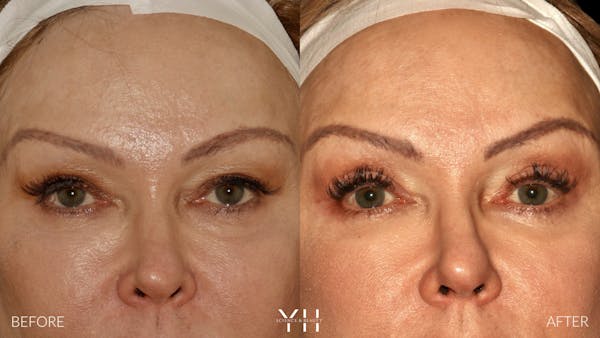  Blepharoplasty Before & After Gallery - Patient 328344 - Image 1